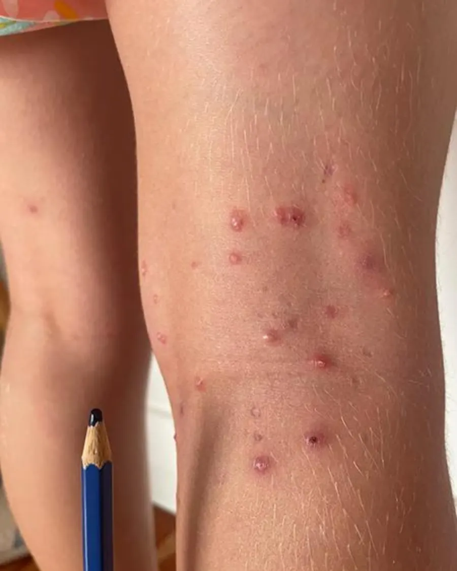 Molluscum contagiosum at Cinch Clinics